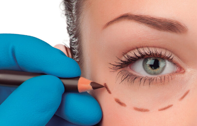 Cirurgia Oculoplástica melhora a expressão do olhar