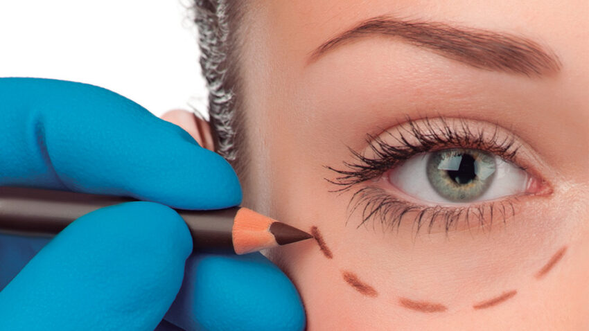 Cirurgia Oculoplástica melhora a expressão do olhar