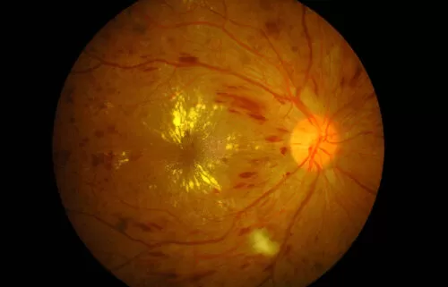 Retinopatia Diabética