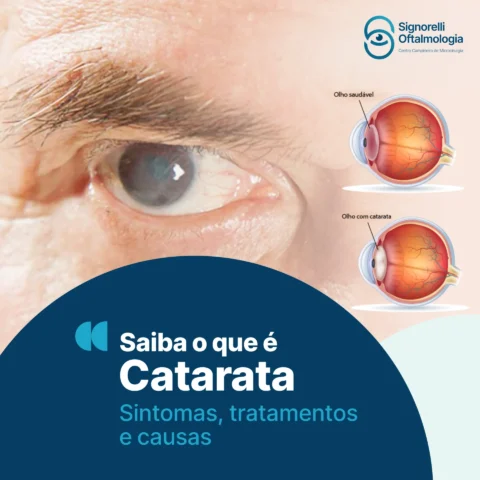 Saiba o que é catarata: sintomas, tratamentos e causas