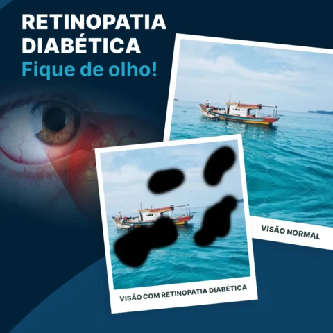 Retinopatia Diabética: É possível prevenir?