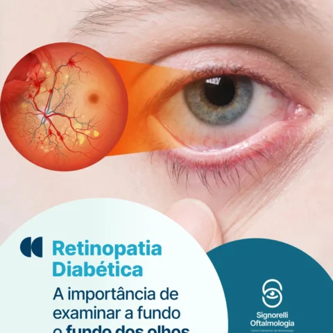 Retinopatia Diabética